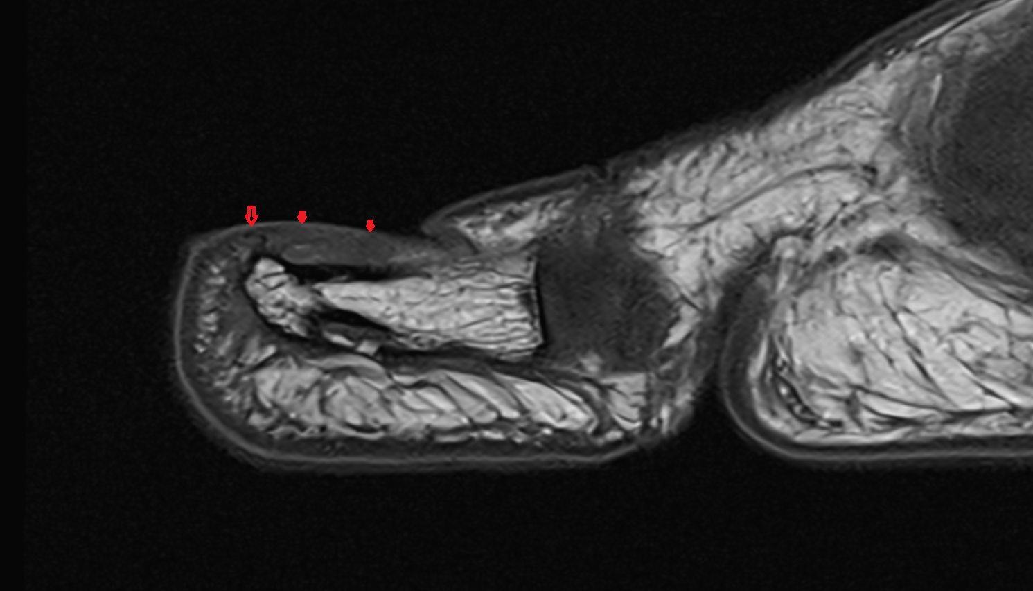 Nail of toe sag cross sectional anatomy 3T MRI AI enhanced radiology image-img-00000-00000