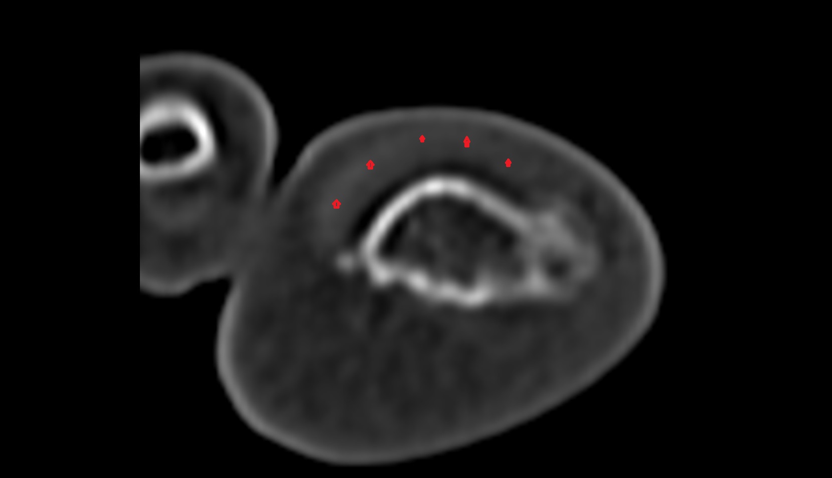 Nail root ct axial image