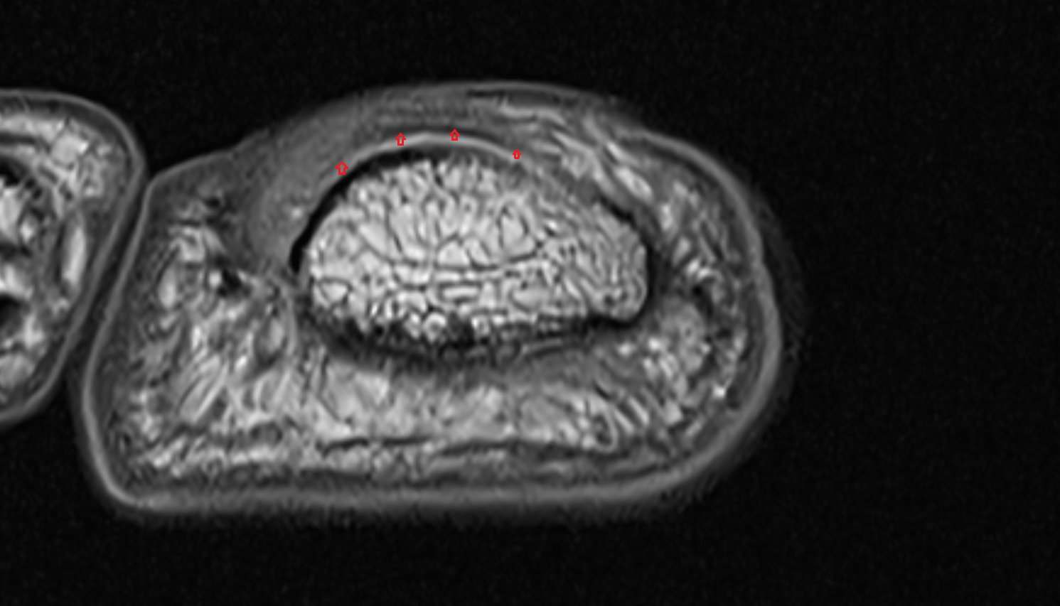 Nail root of toe axial cross sectional anatomy 3T MRI AI enhanced radiology image-img-00000-00000
