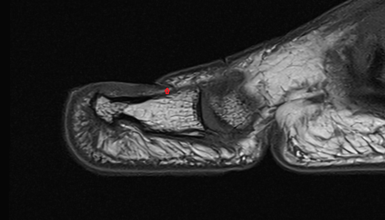 Nail root of toe sag cross sectional anatomy 3T MRI AI enhanced radiology image-img-00000-00000_00001