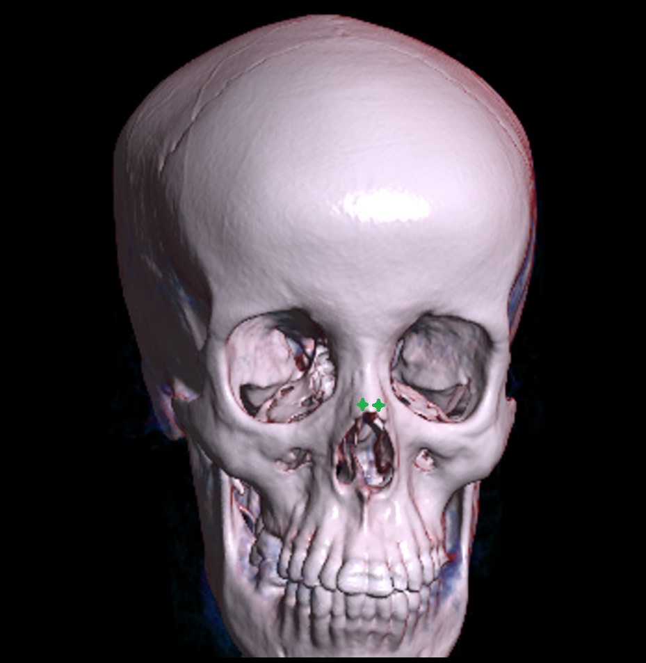 Nasal bone 3d