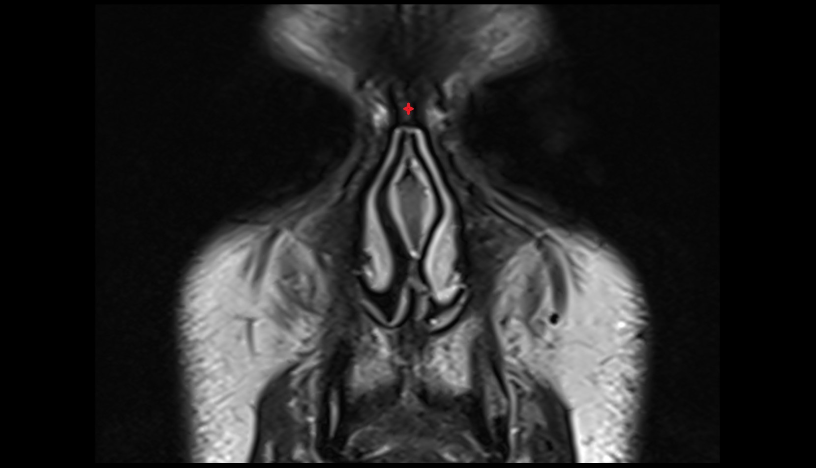 Nasal bones coronal mri image