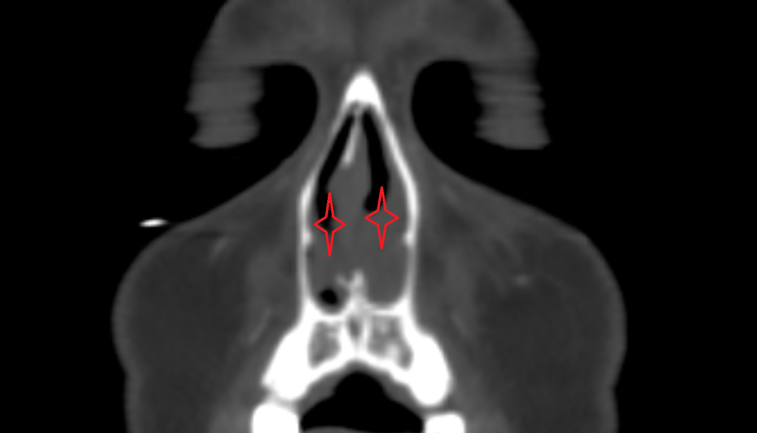 Nasal cavity  CT  anatomy labelled image-img-00000-00000