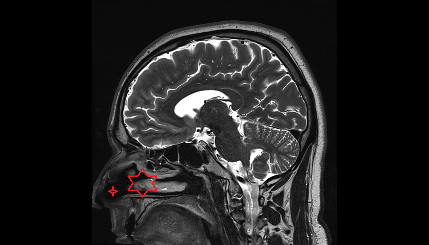 Nasal cavity  mr  anatomy labelled image-img-00000-00000