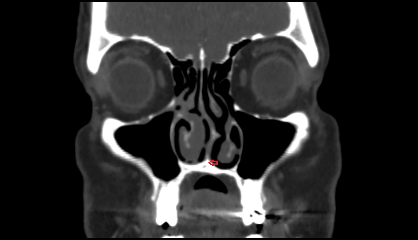 Nasal crest of maxilla CT
