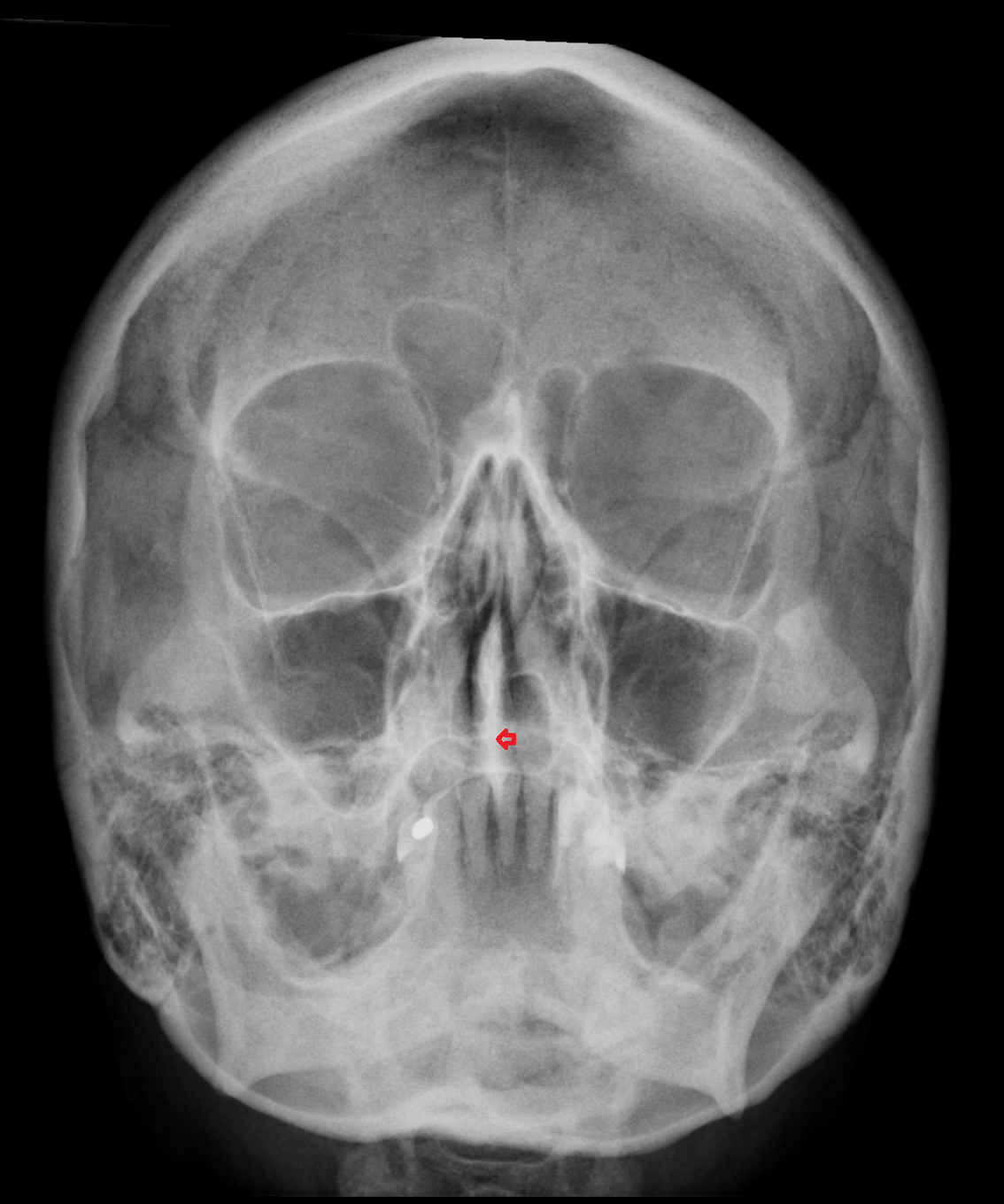 Nasal crest of maxilla X RAY