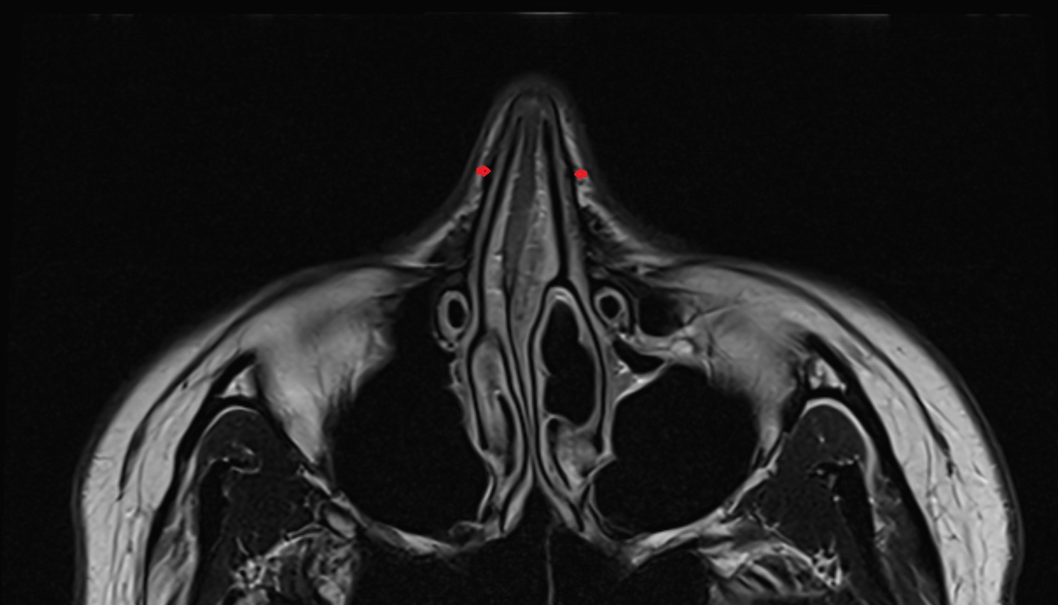Nasalis muscle  mri axial image -img-00000-00000
