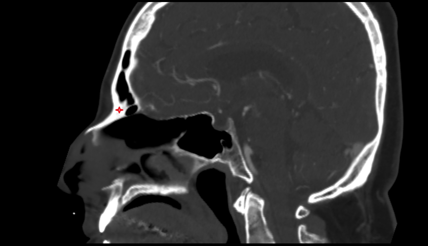 Nasal part of frontal bone ct sag
