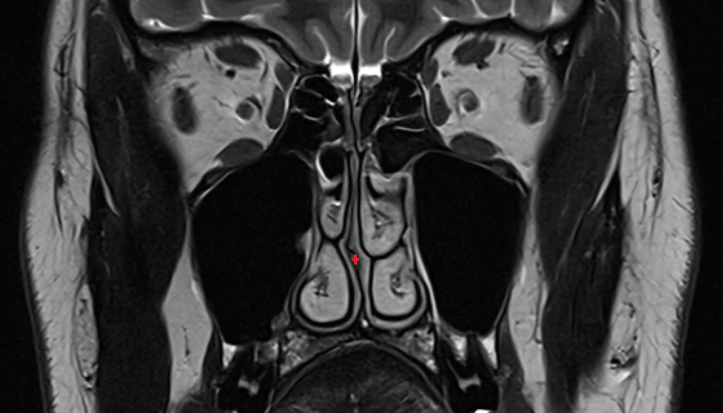 Nasal septum  mri axial  image -img-00000-00000