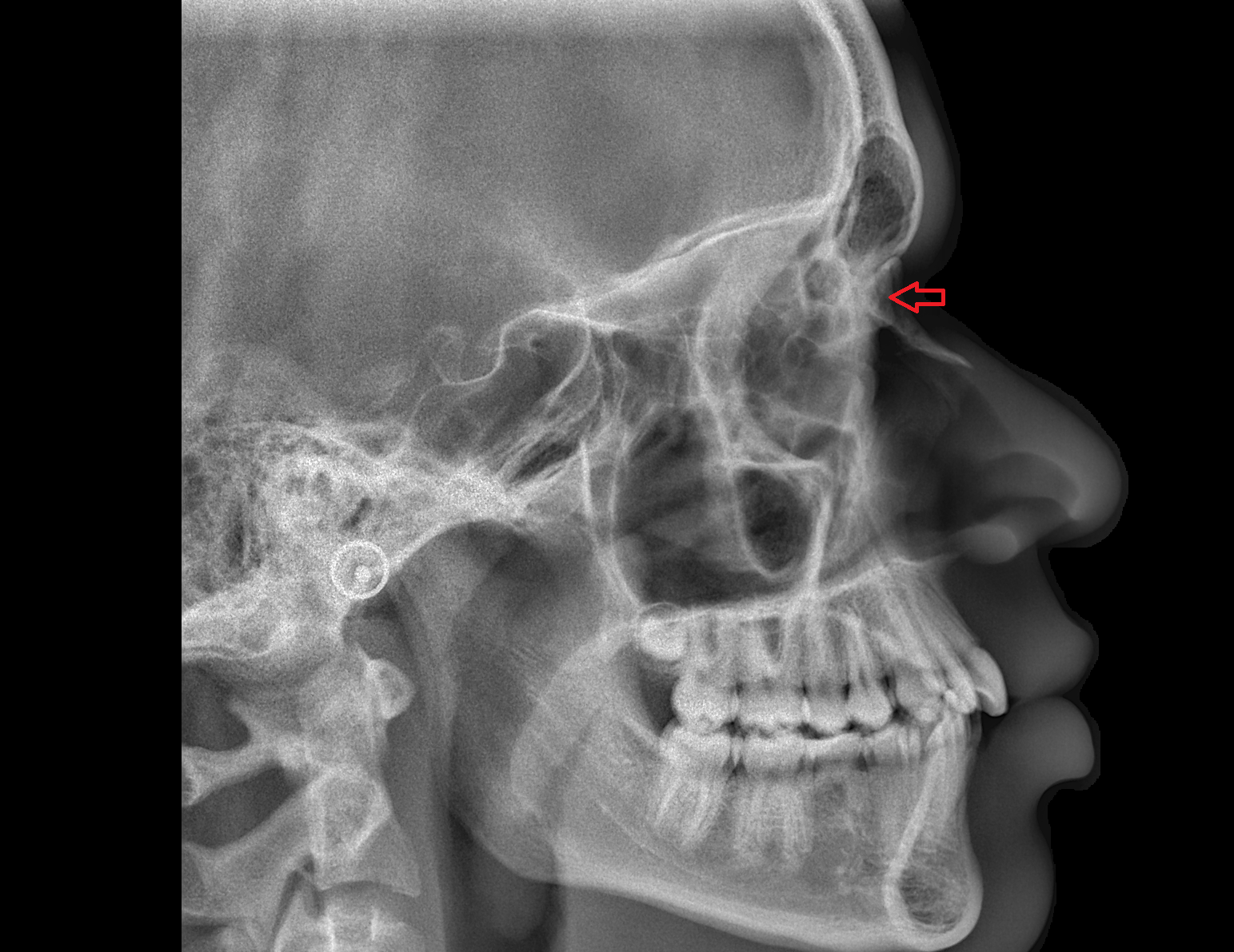 Nasal spine of frontal bone