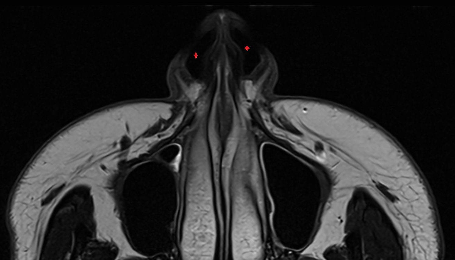 Nasal vestibule mri axial  image -img-00000-00000