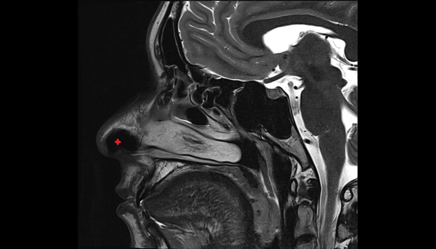 Nasal vestibule mri sag  image -img-00000-00000