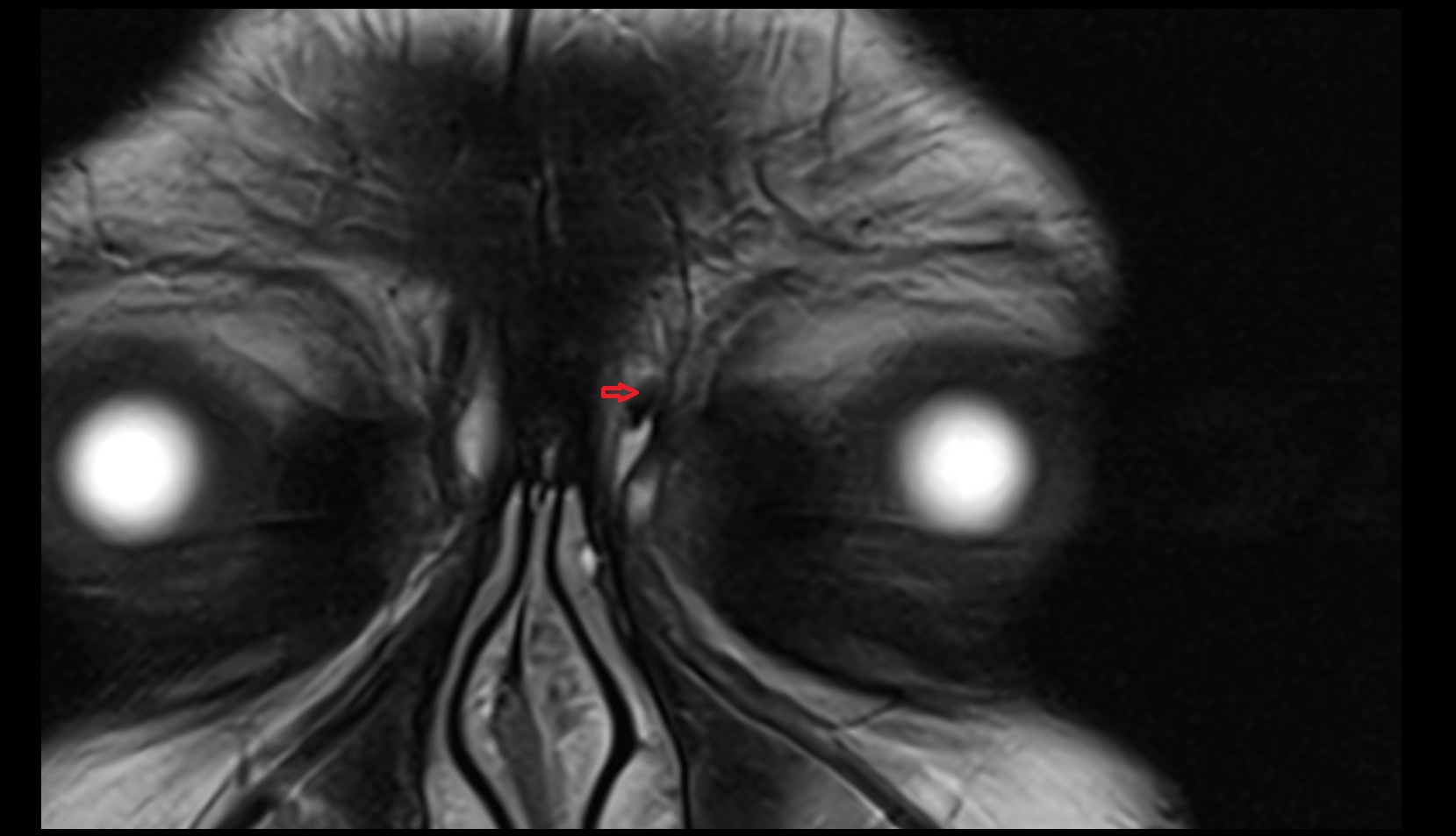 Nasofrontal vein mri image