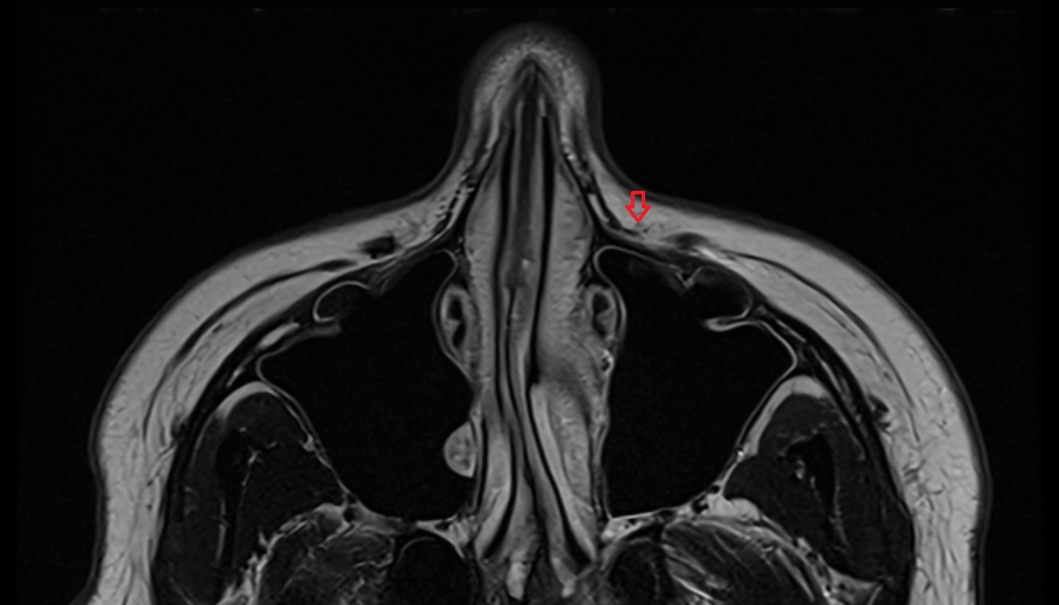 Nasolabial lymph nodes mri axial  image -img-00000-00000