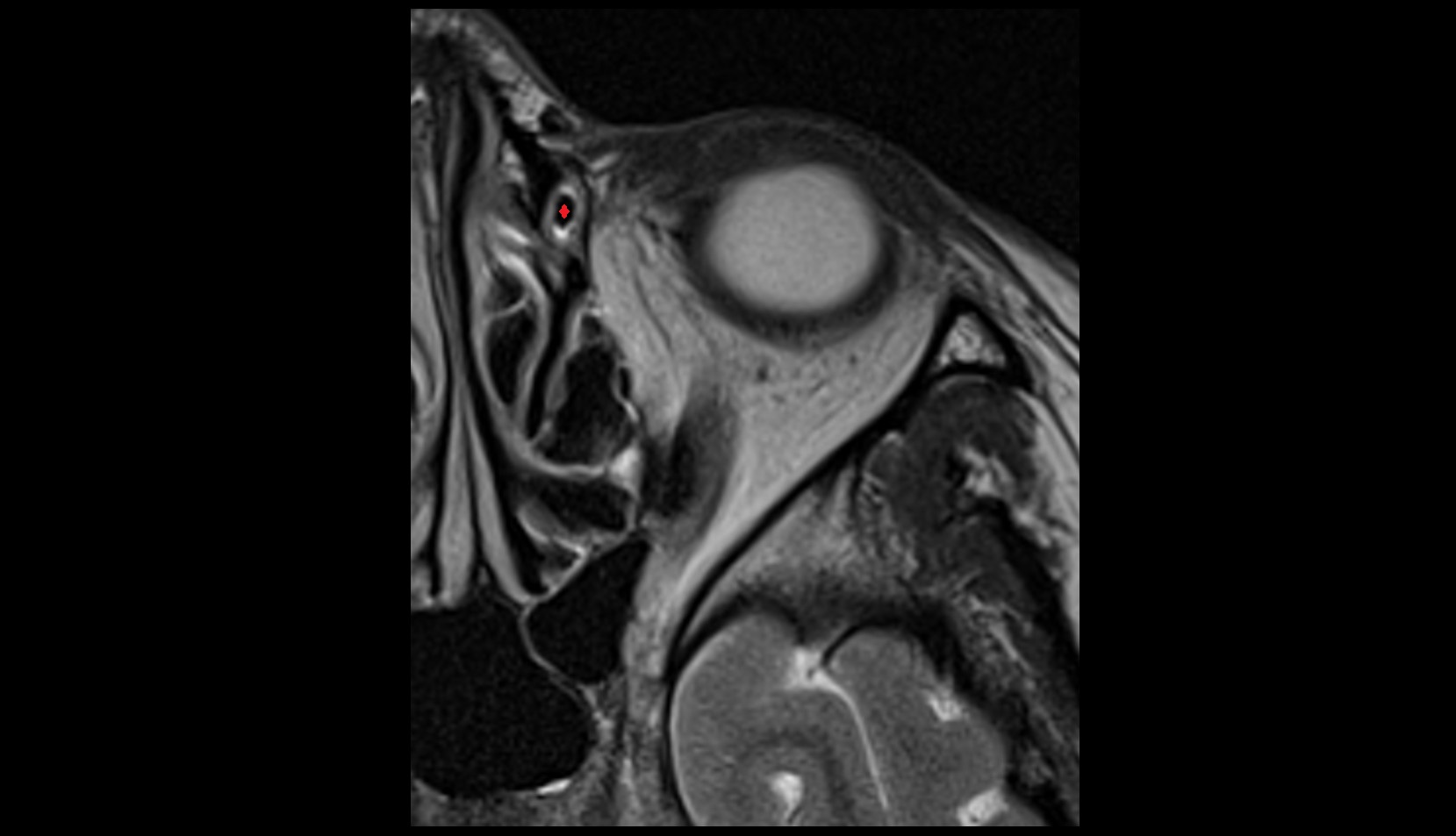 Nasolacrimal duct (Tear duct) mri