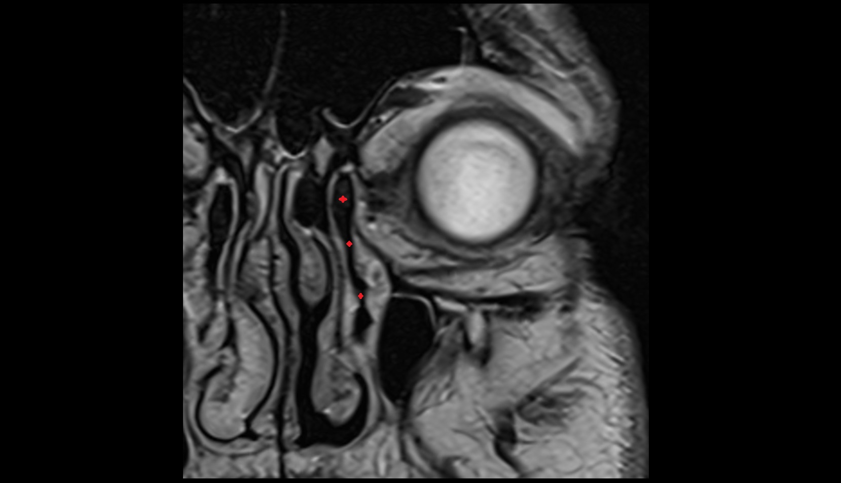Nasolacrimal duct (Tear duct) mri image