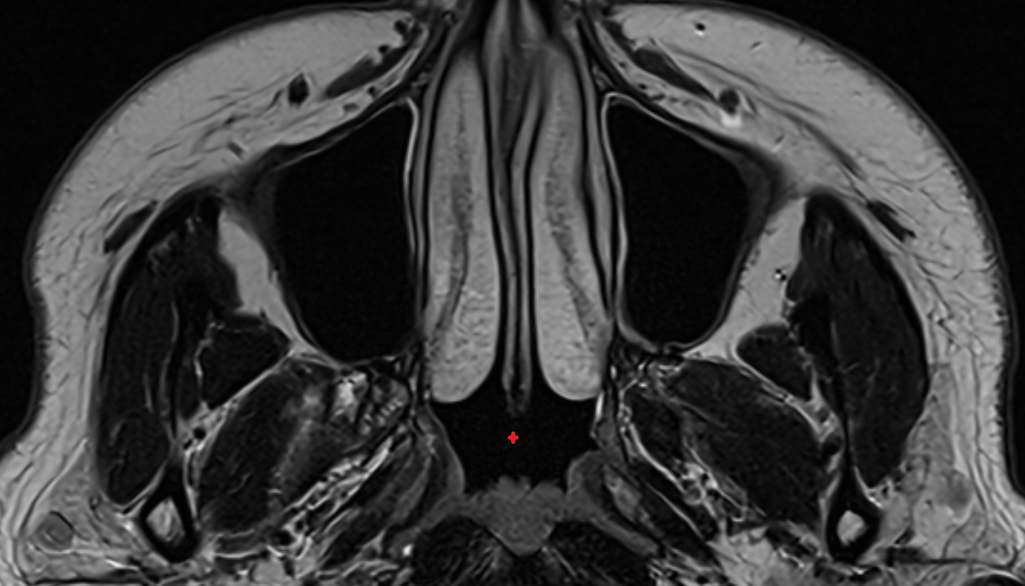 Nasopharynx mri axial  image -img-00000-00000