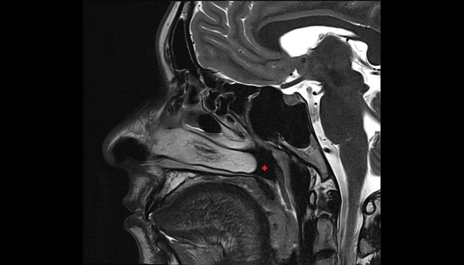 Nasopharynx mri sag image -img-00000-00000