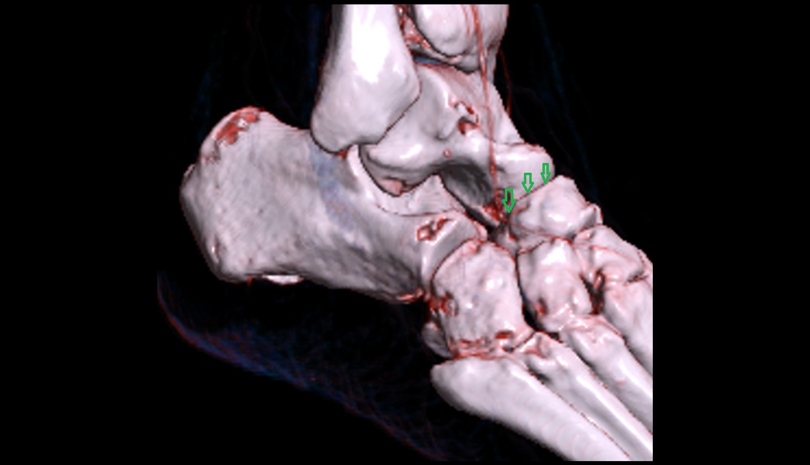 Navicular articular surface 3d