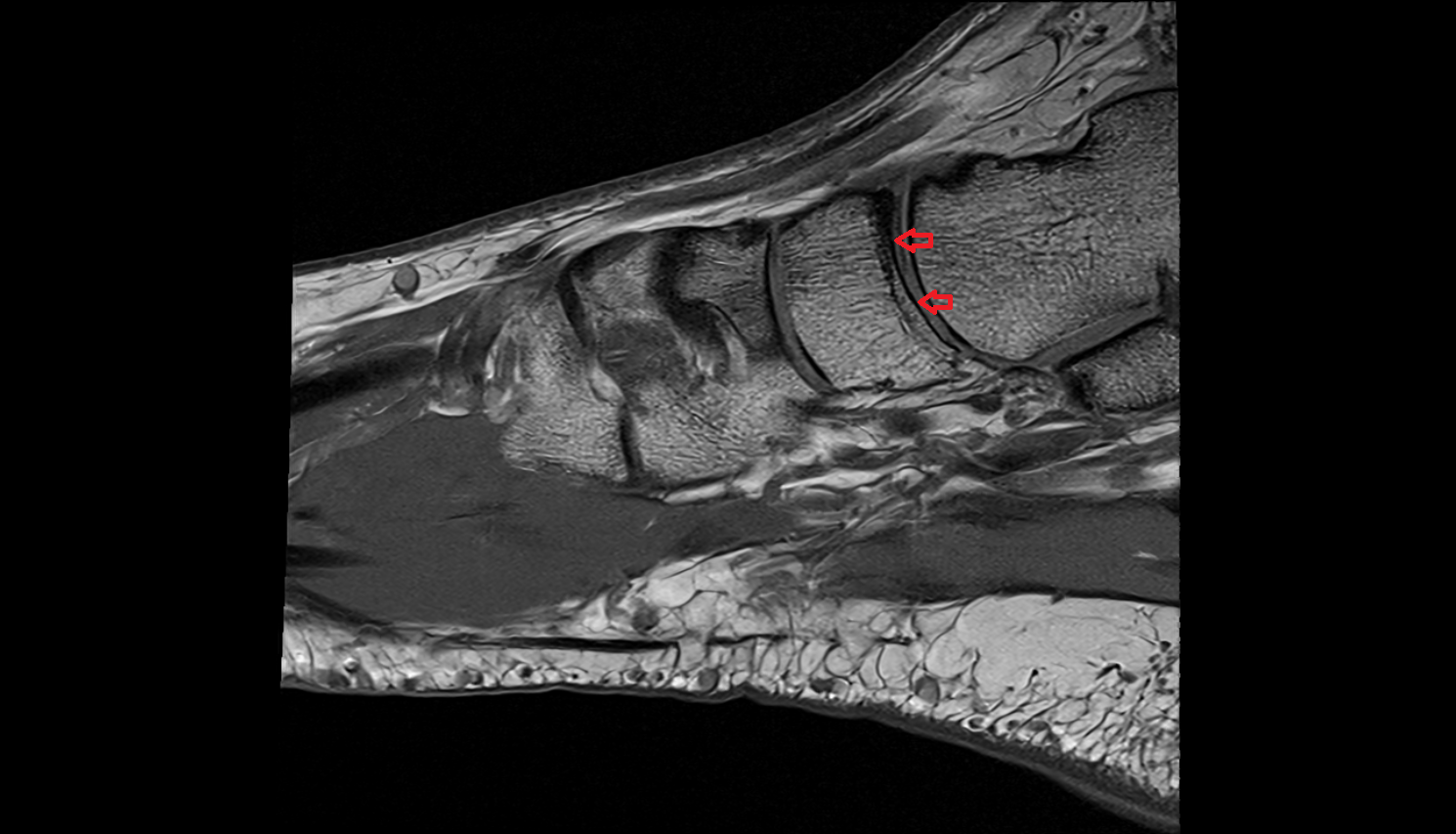 Navicular articular surface  mri  anatomy labelled image-img-00000-00000
