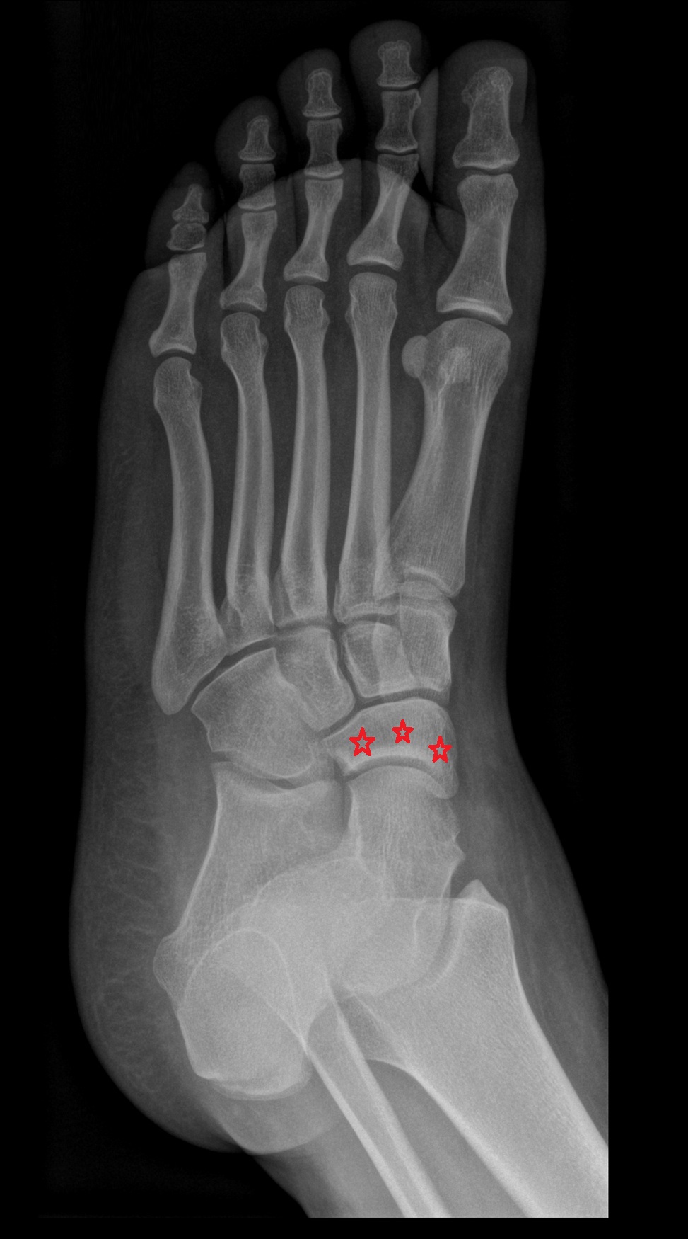 Navicular bone