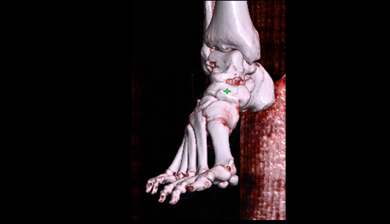 Navicular bone 3d vrt image