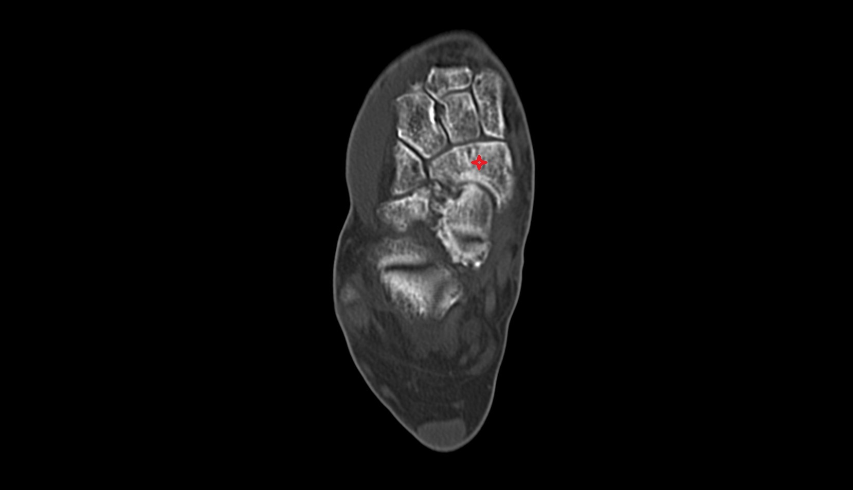 Navicular bone ct axial image