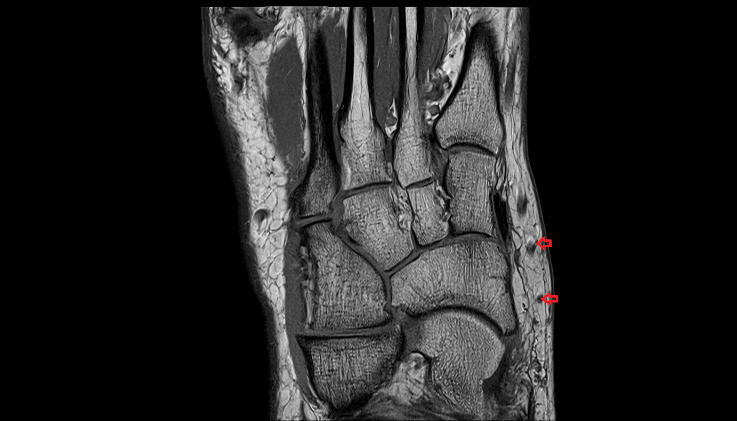 Navicular perforator veins  footaxial cross sectional anatomy 3T MRI AI enhanced radiology image-img-00000-00000