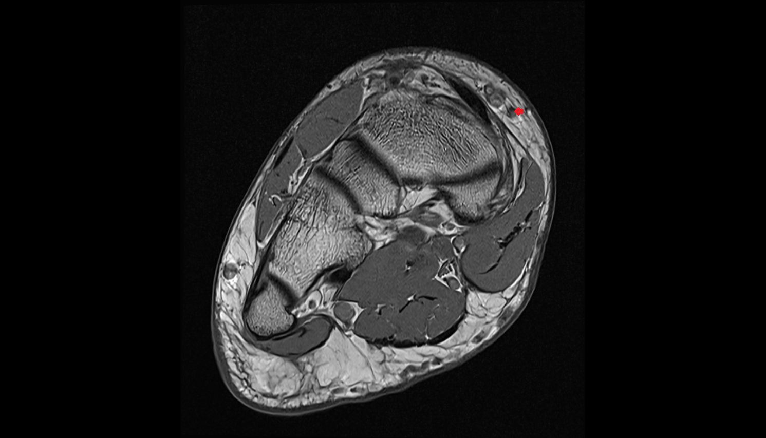 Navicular perforator veins  foot coronal cross sectional anatomy 3T MRI AI enhanced radiology image-img-00000-00000