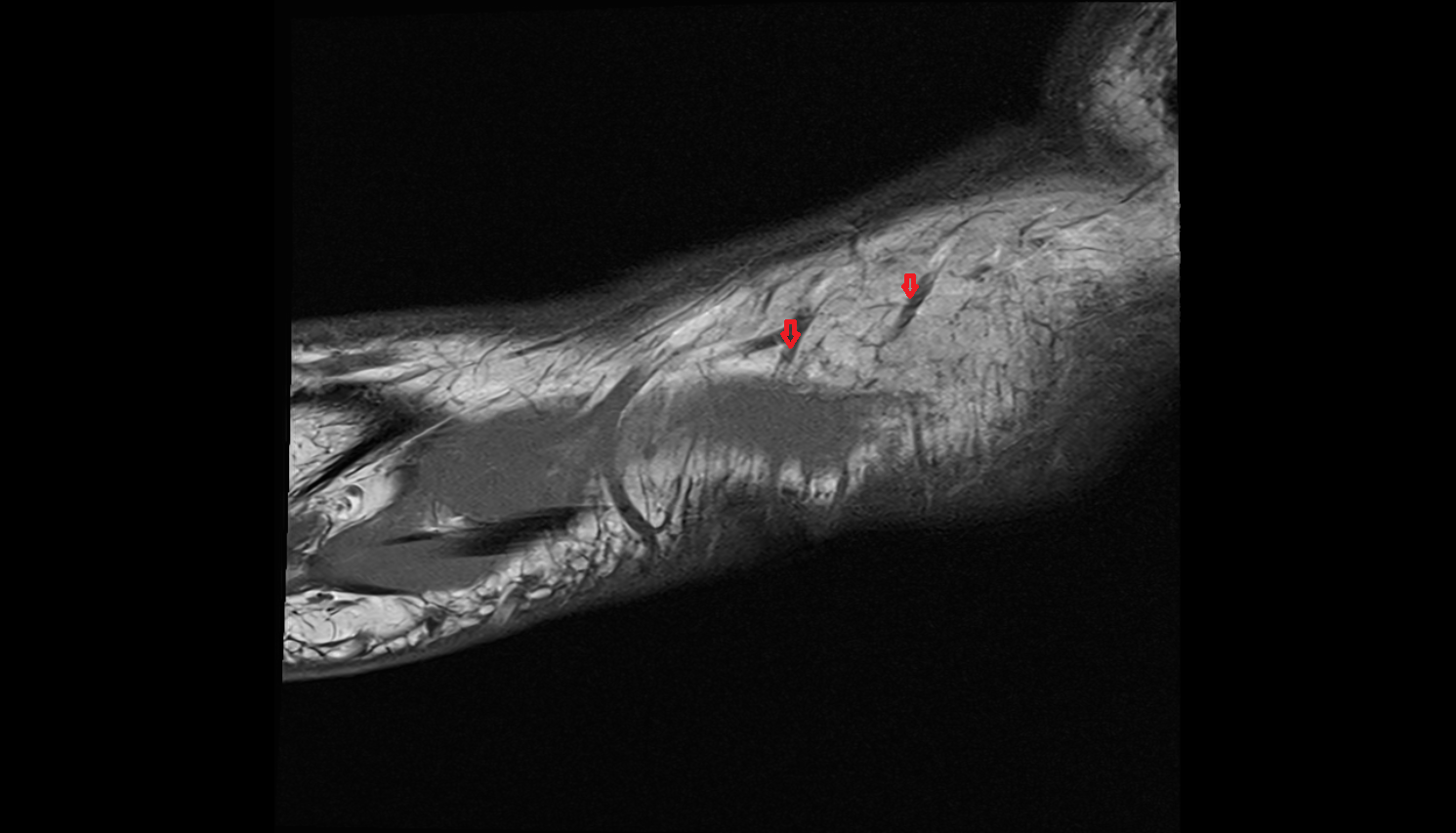 Navicular perforator veins  foot  sag cross sectional anatomy 3T MRI AI enhanced radiology image-img-00000-00000