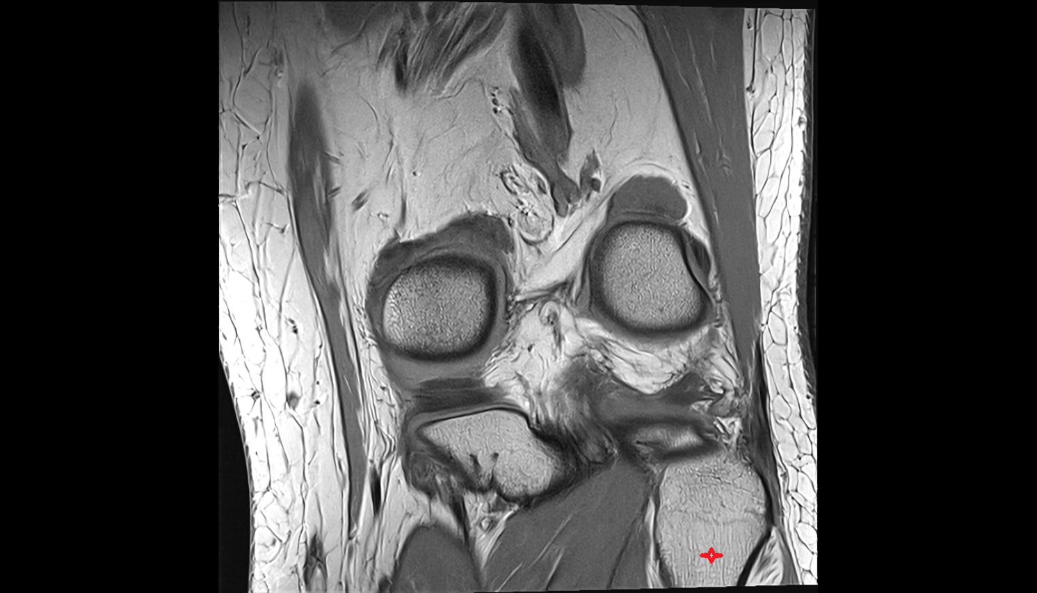 Neck of fibula  coronal cross sectional anatomy 3T MRI AI enhanced  radiology  anatomy image-img-00000-00000