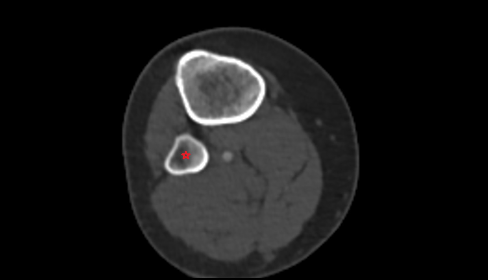 Neck of fibula ct axial