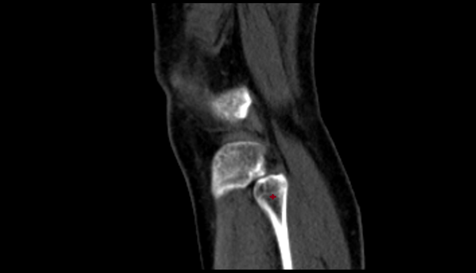 Neck of fibula ct sagittal