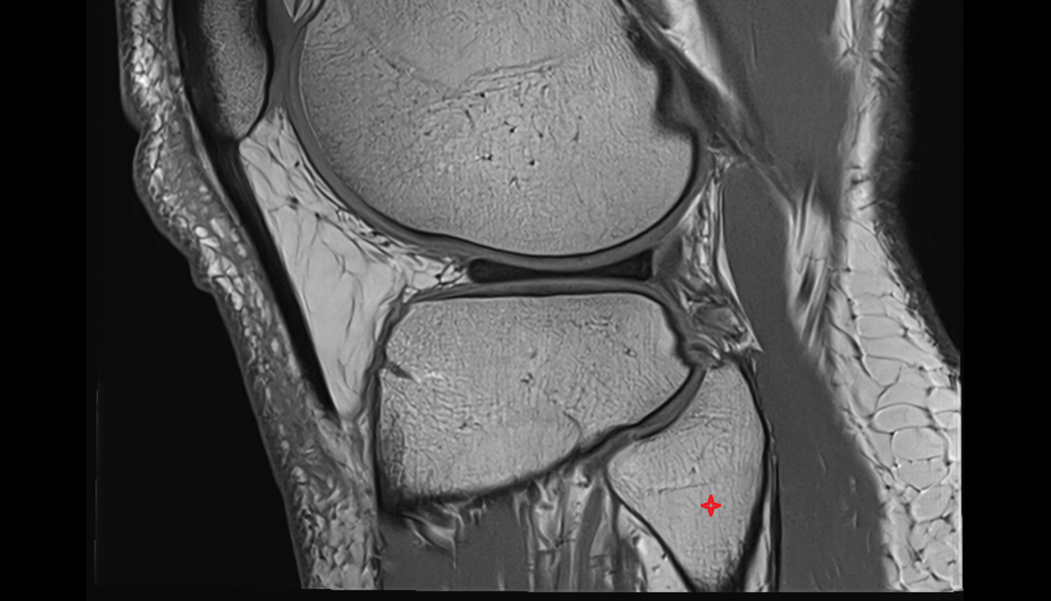 Neck of fibula  sag cross sectional anatomy 3T MRI AI enhanced  radiology  anatomy image-img-00000-00000