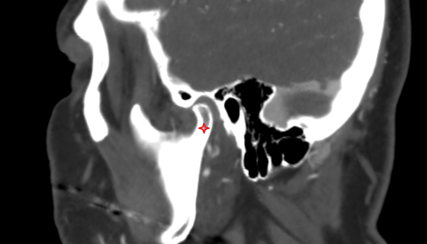 Neck of mandible CT  anatomy image -img-00000-00000