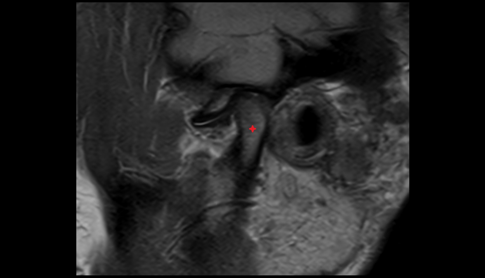 Neck of mandible mri