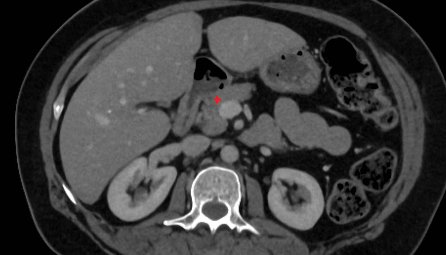 Neck of pancreas  CT  axial  anatomy image-img-00000-00000