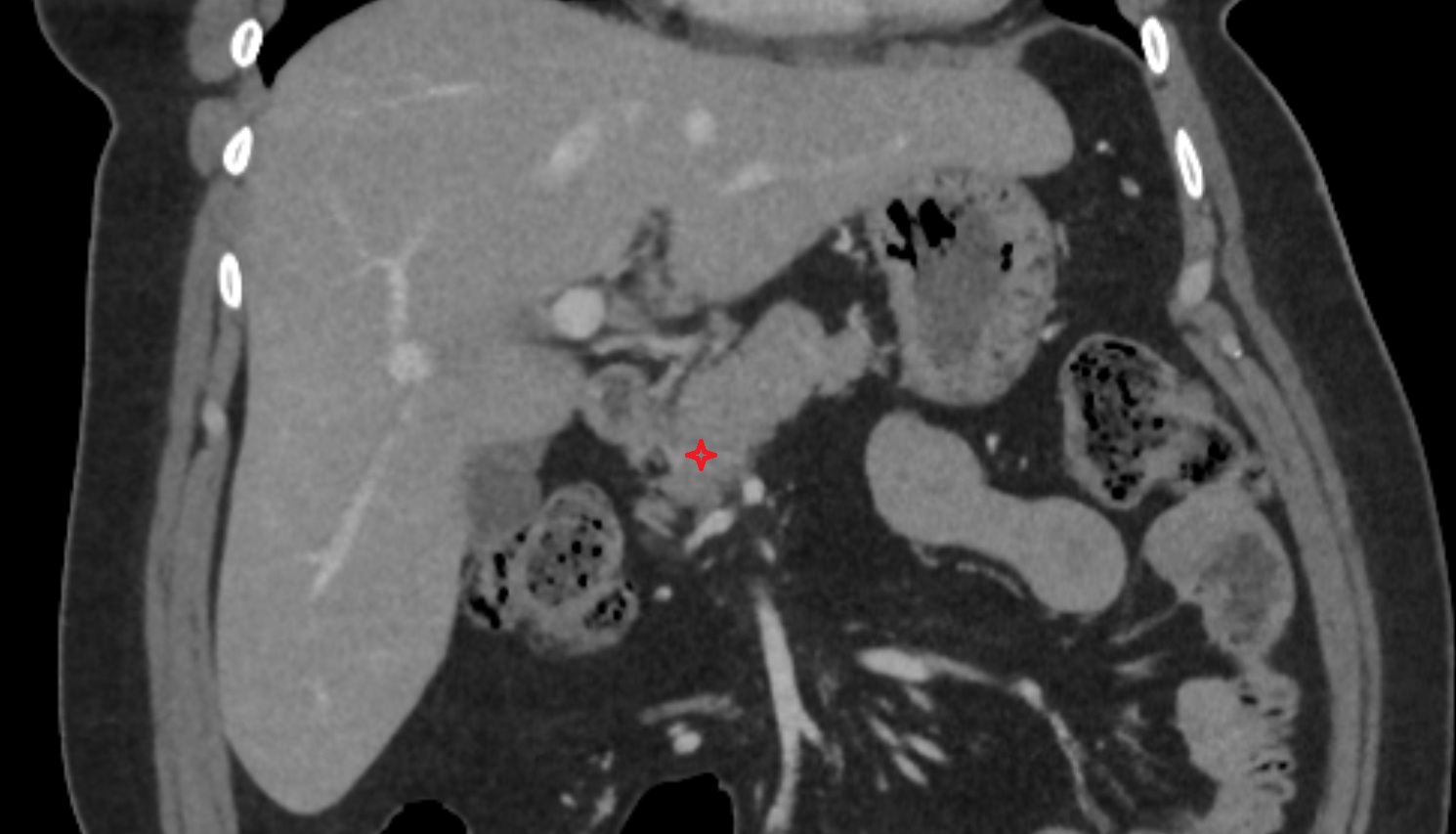 Neck of pancreas CT  coronal  anatomy image-img-00000-00000