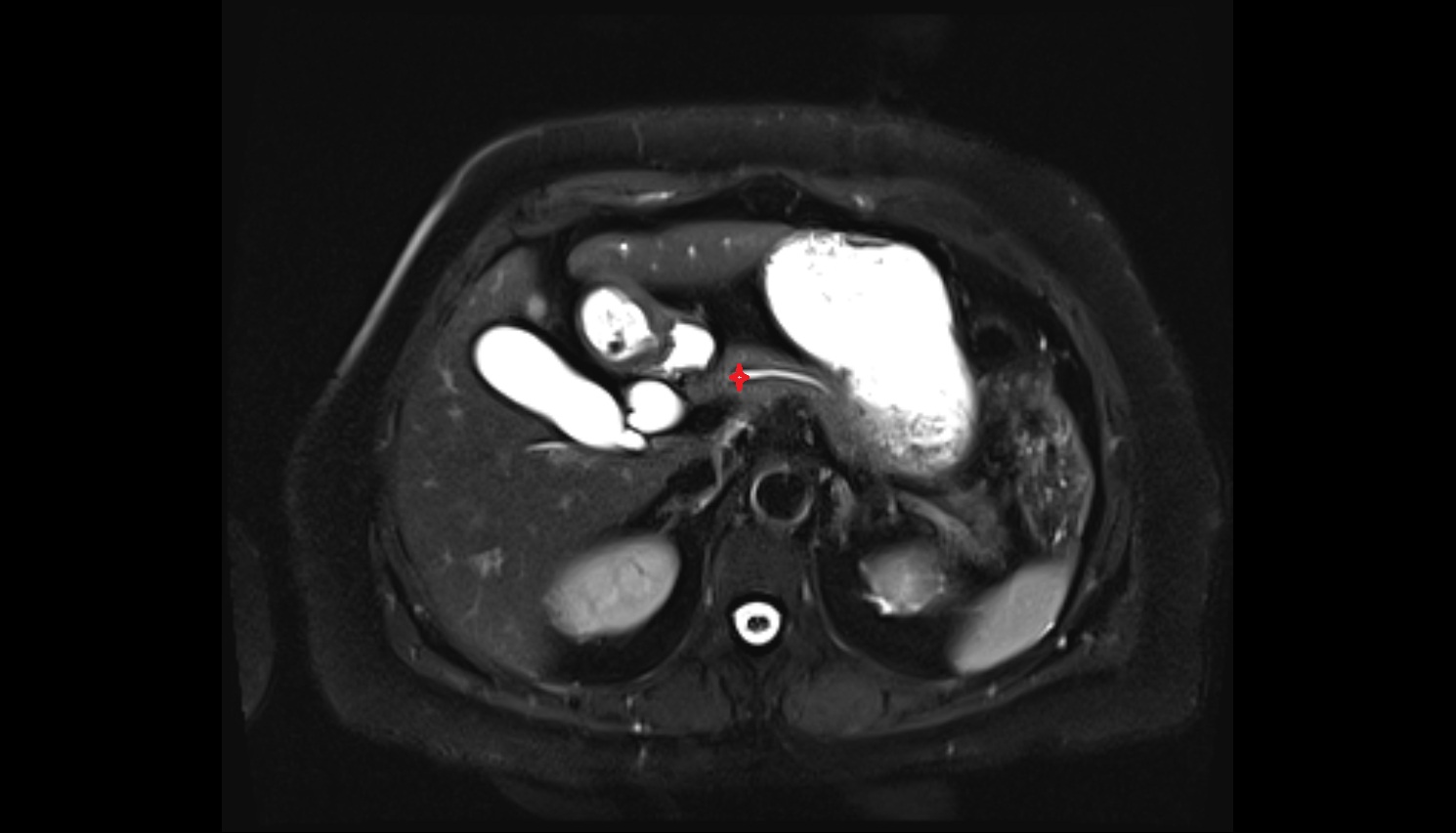 Neck of pancreas  MRI axial  anatomy image-img-00000-00000