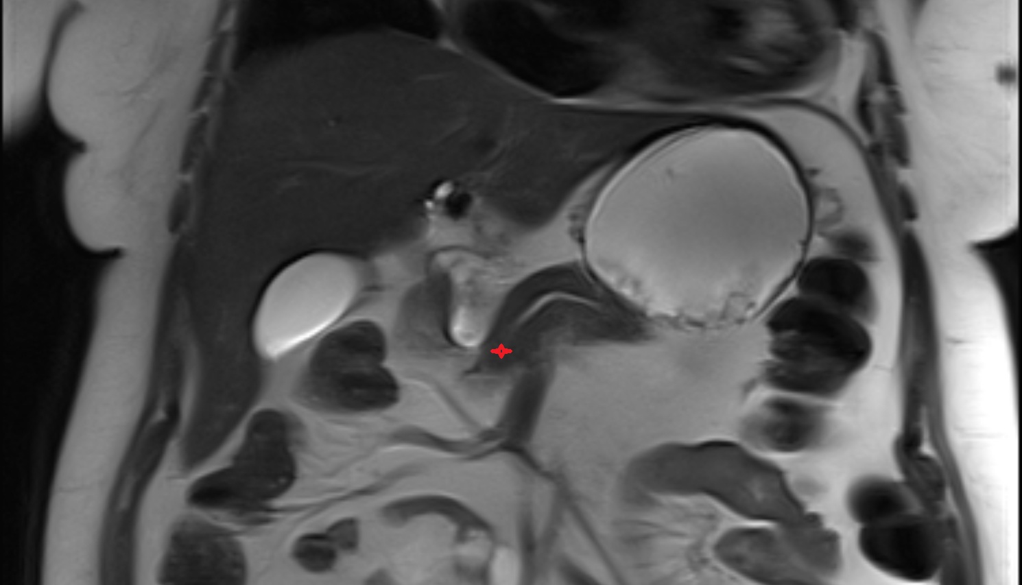 Neck of pancreas  MRI coronal  anatomy image-img-00000-00000