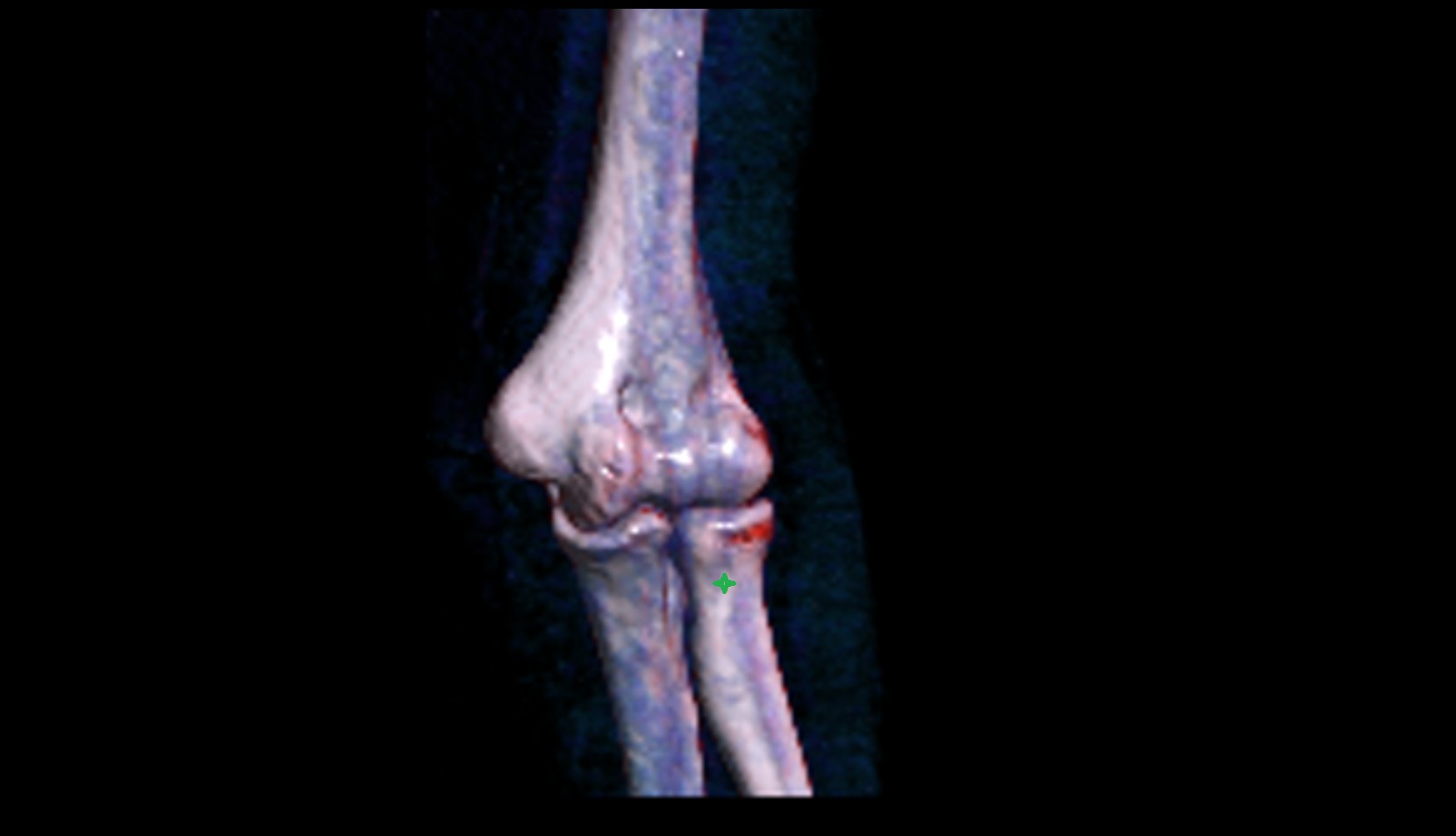 Neck of radius 3D VRT IMAGE