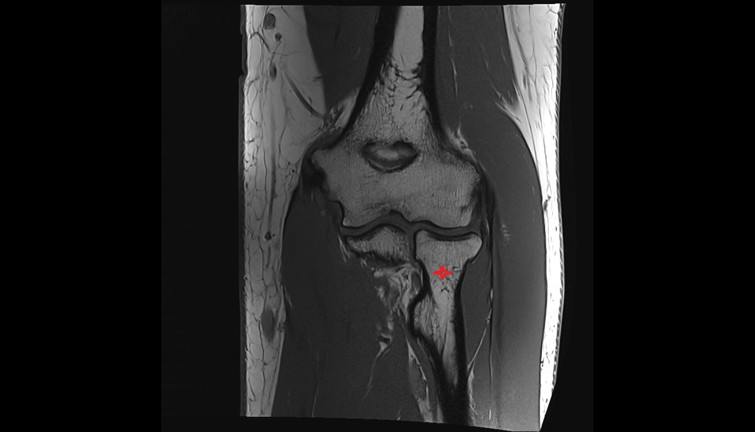 Neck of radius coronal  cross sectional anatomy 3T MRI AI enhanced radiology image -img-00000-00000