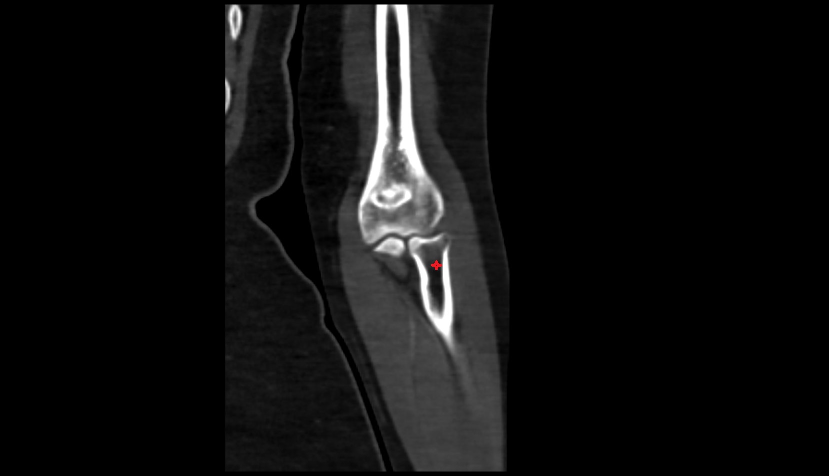 Neck of radius ct image