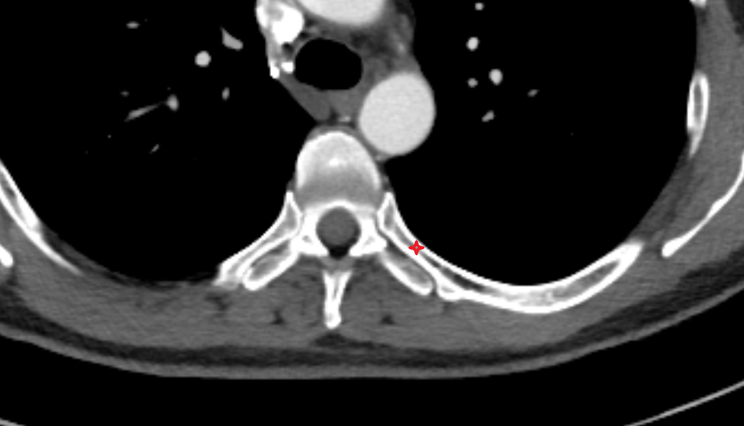Neck of rib CT Anatomy, Location and Imaging Appearance  -img-00000-00000
