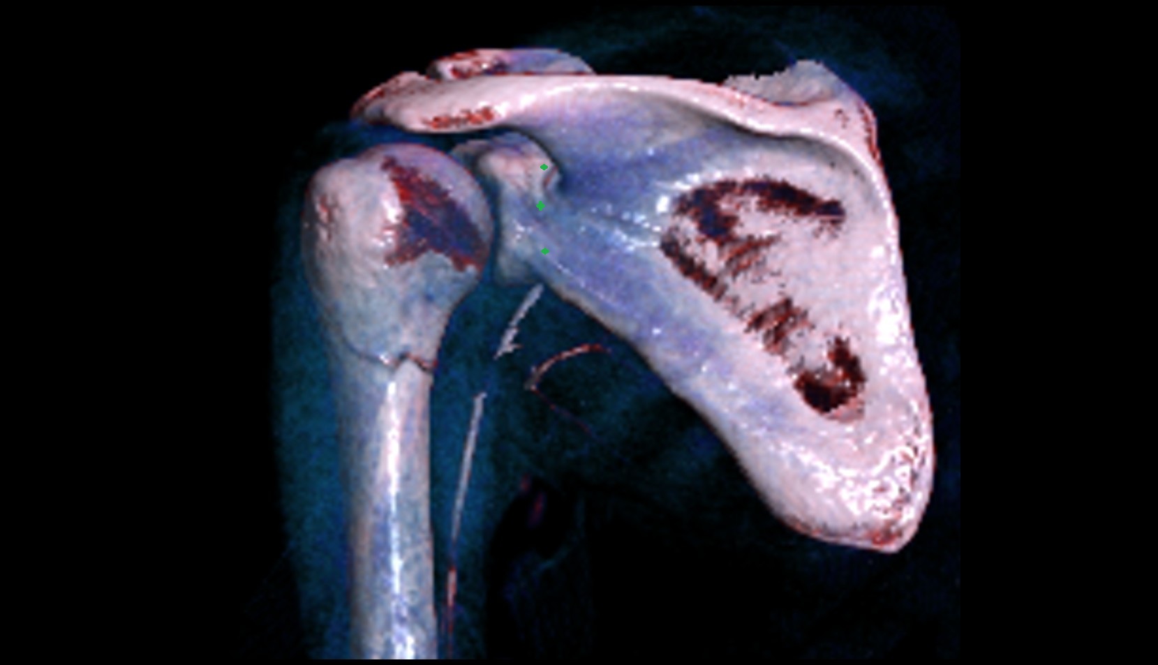 Neck of scapula 3d image