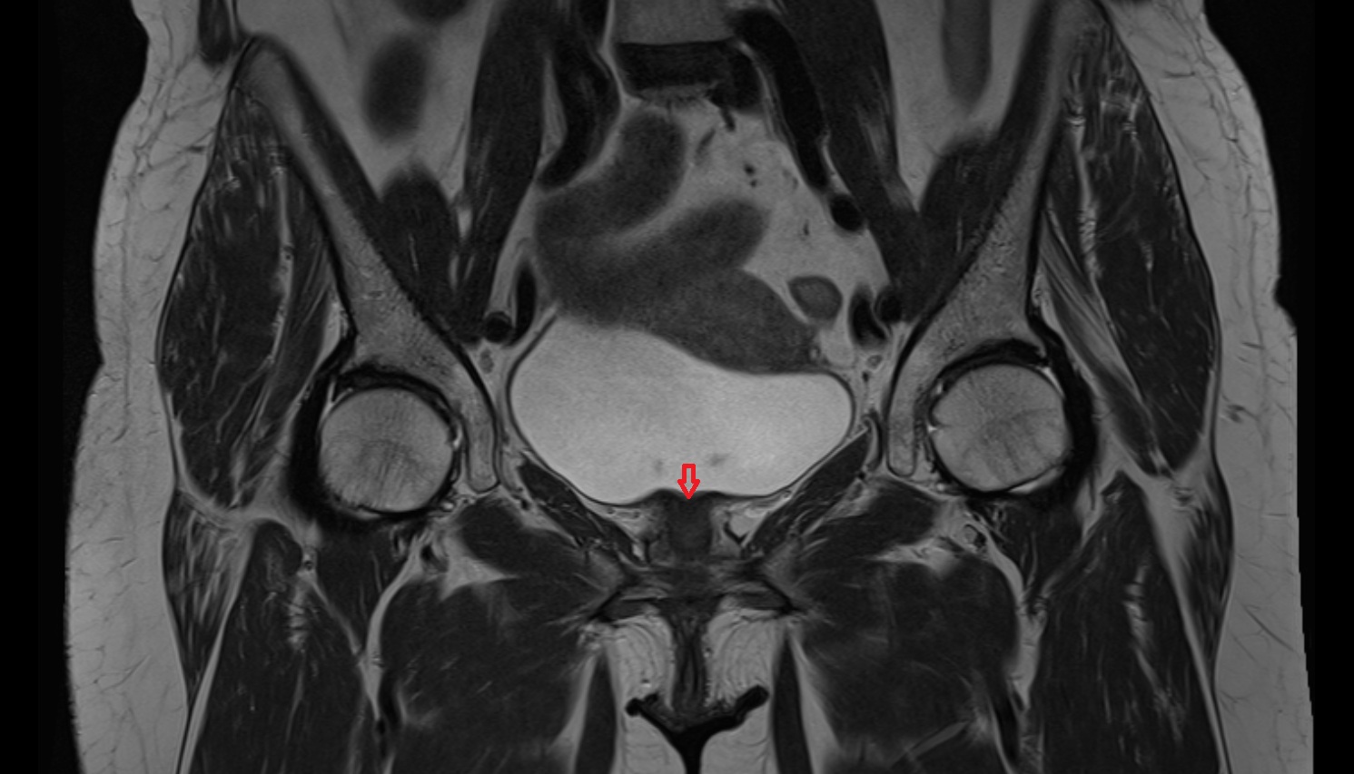 Neck of urinary bladder  mri coronal anatomy  image-img-00000-00000
