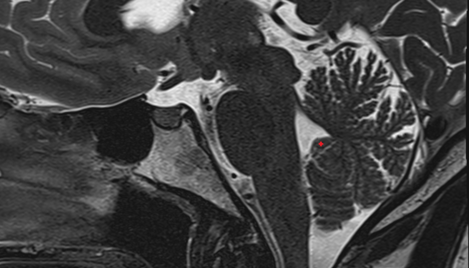 Nodule of Vermis (X)  of Cerebellum mri sag  image -img-00000-00000