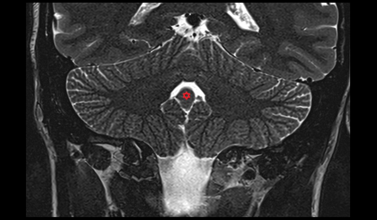 Nodule of vermis MRI 3T coronal image