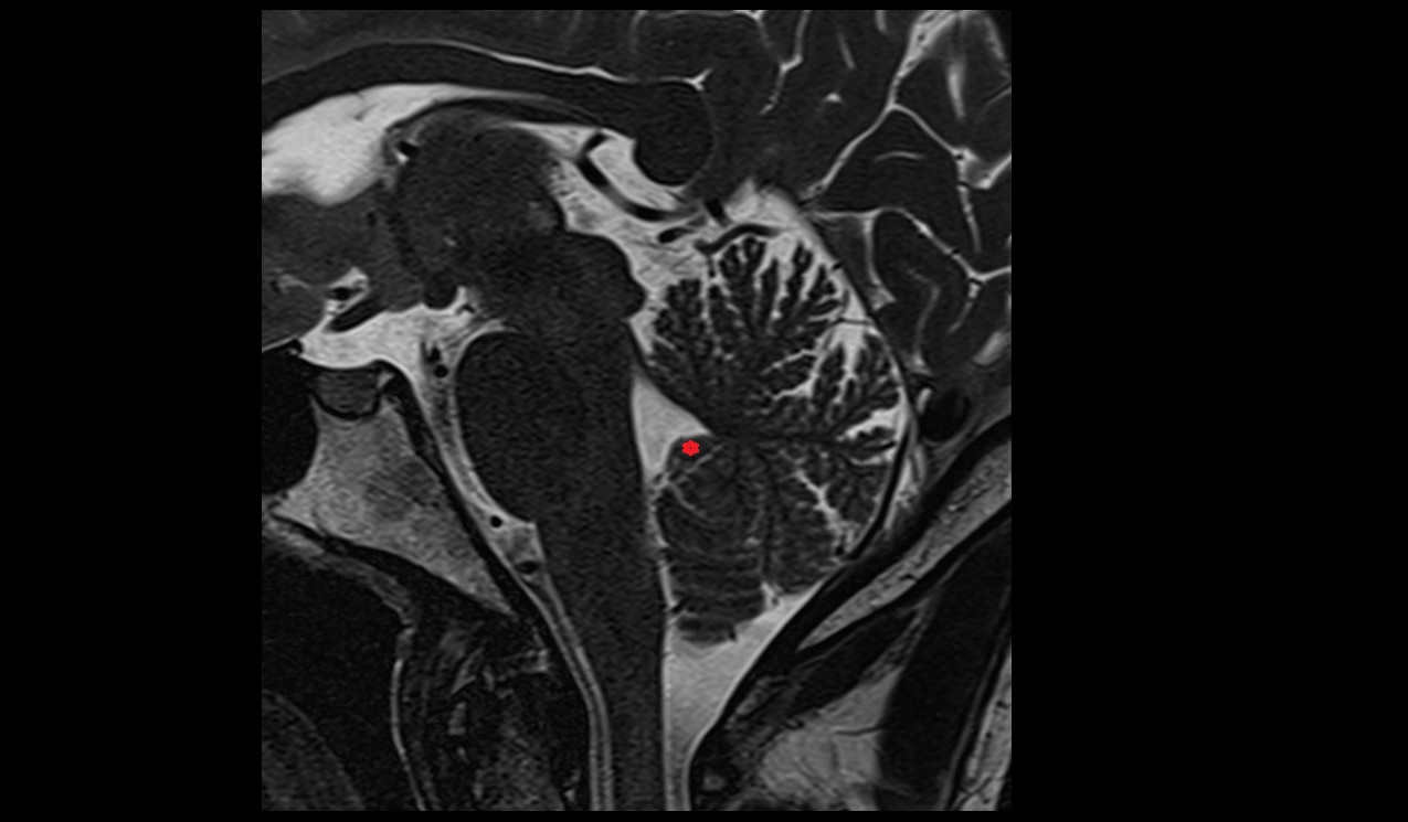 Nodule of vermis MRI 3T sagittal image
