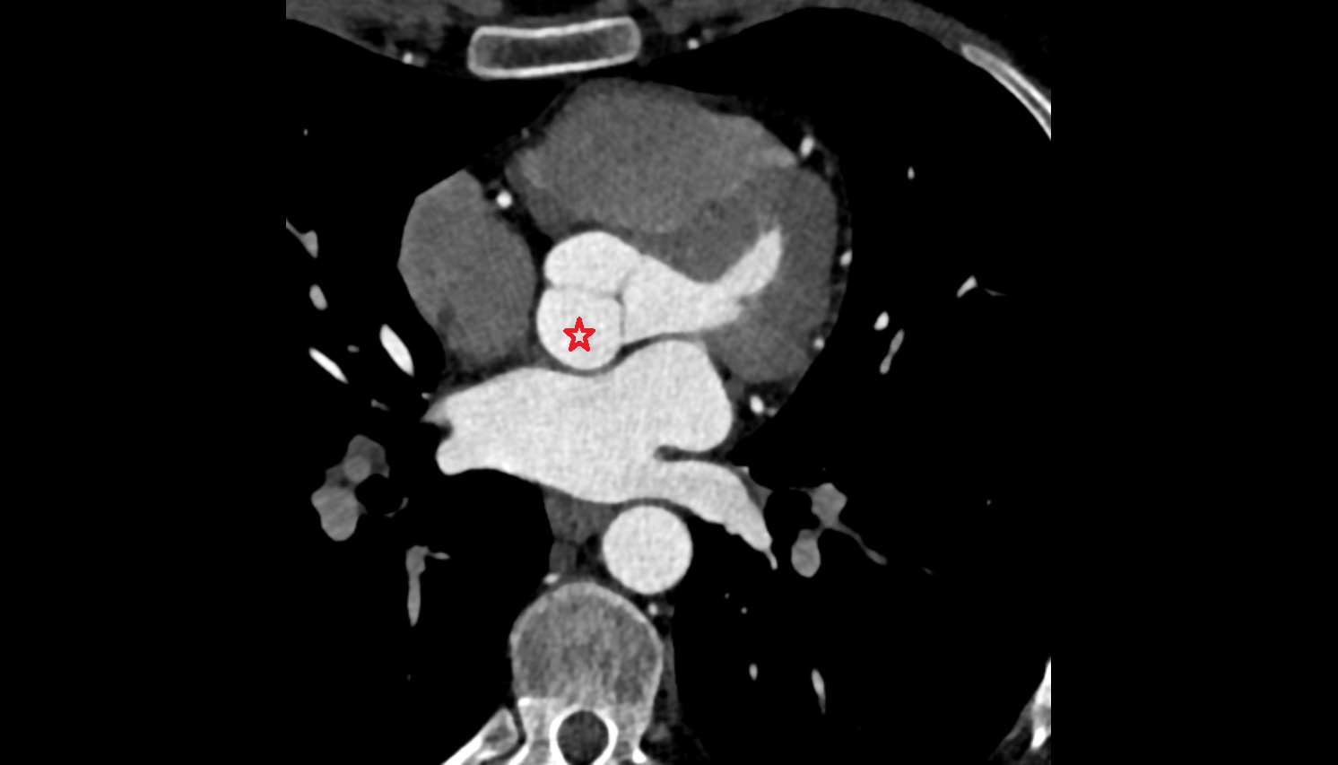 Noncoronary aortic sinus CT axial   image -img-00000-00000